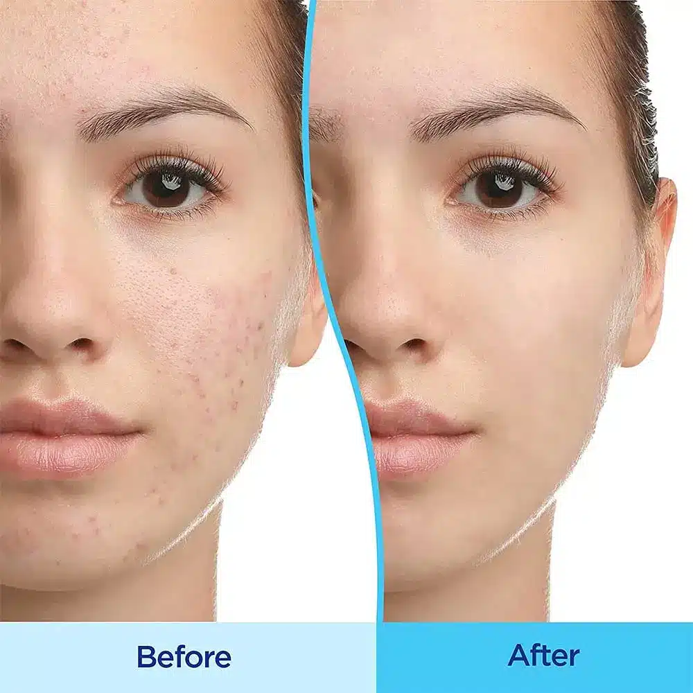 ژل ضدجوش و لایه بردار دیفرین