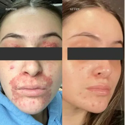 سرم تسکین دهنده آزلائیک اسید مدی کیوب 30 میل Medicube Azelaic Acid 16 BB Calming Serum