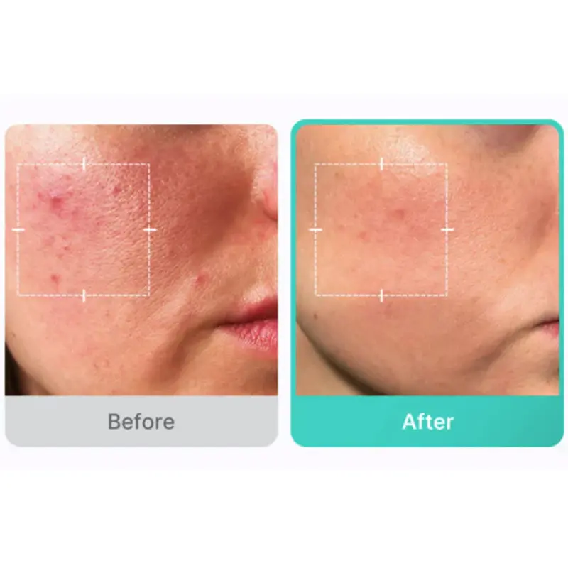 سرم تسکین دهنده آزلائیک اسید مدی کیوب 30 میل Medicube Azelaic Acid 16 BB Calming Serum