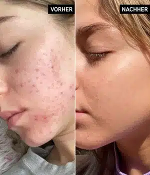 سرم نیاسینامید اینکی لیست 30میل Niacinamide Serum The INKEY List